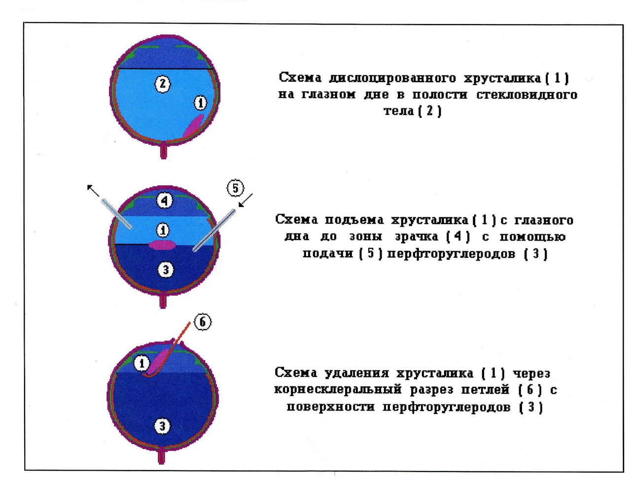 ПФОС в офтальмологии (Воробьев С.И.)